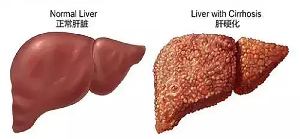 肝功能异常，或会出现“2痒，3黑”如果你有请尽早检查。